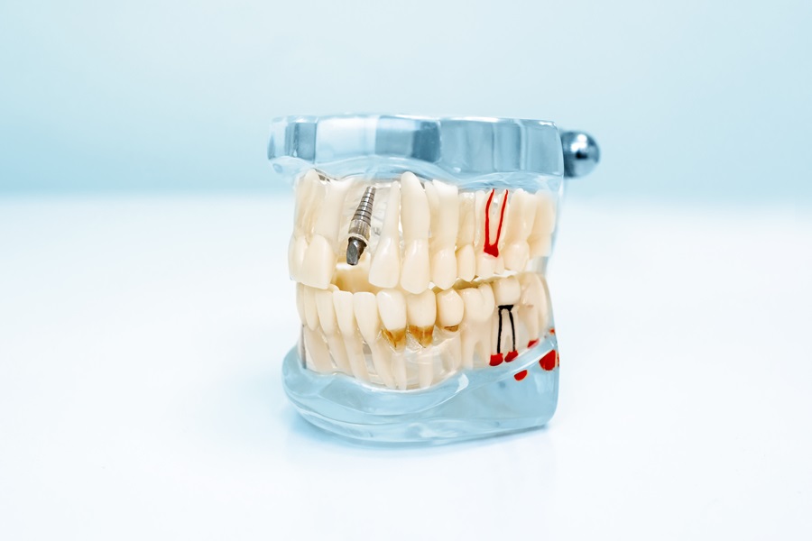 Dental Implants Are A Long-Lasting Replacement For Missing Teeth